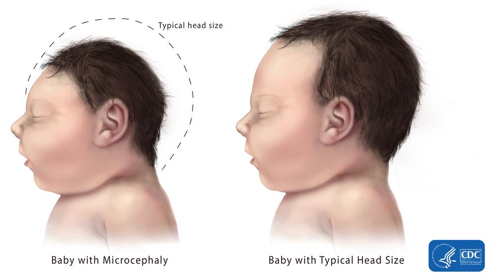 microcephaly-comparison